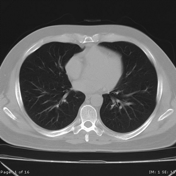 courses:a6m33zsl:ct_lungs.jpg