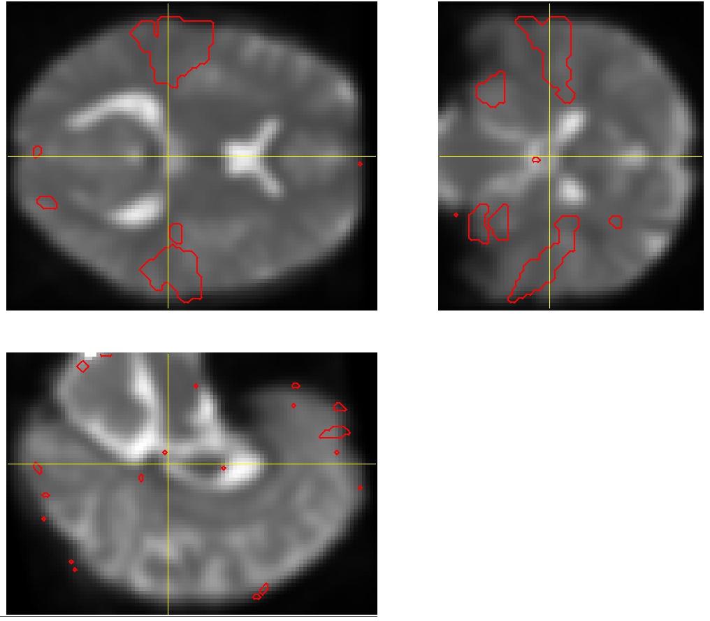 Vizualizace tří navzájem kolmých řezů mozku se zvýrazněnými aktivovanými částmi pomocí nástroje Projector.