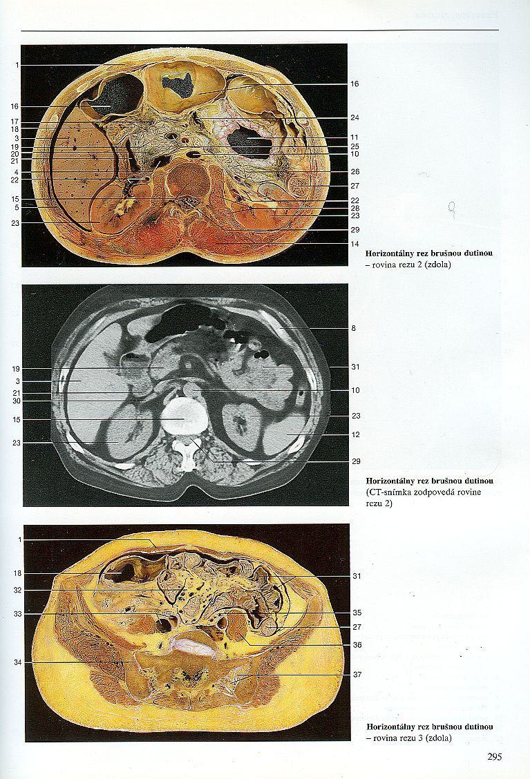 Řez trupem, 2. strana - porovnání anatomického obrazu a obrazu z CT